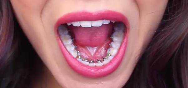 lingual braces