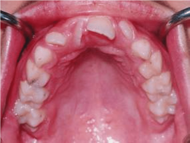 tooth rotation