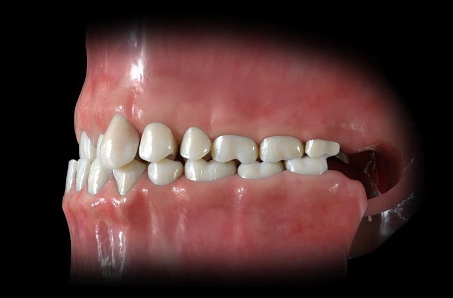 anterior crossbite